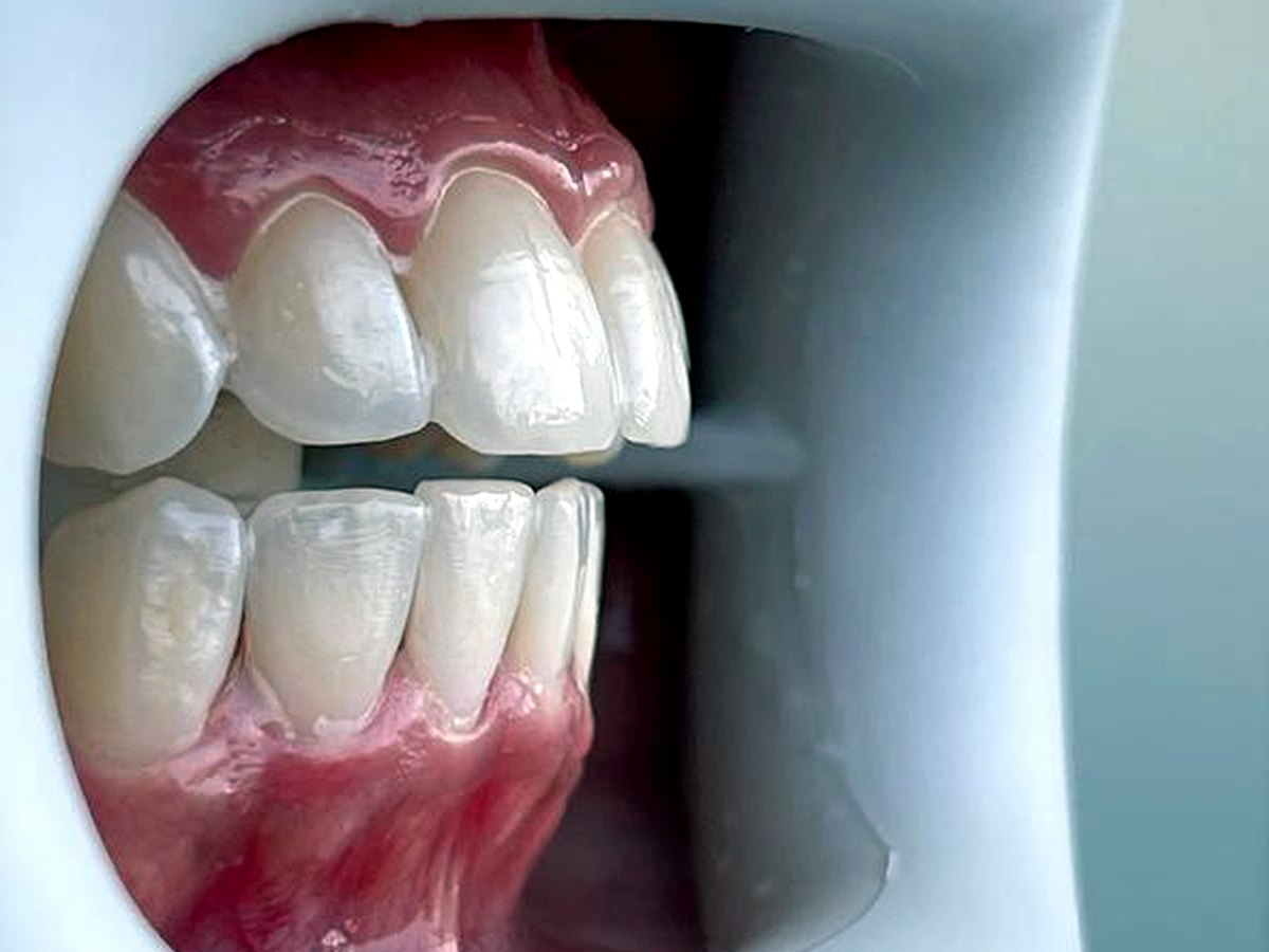Après blanchiment dentaire au fauteuil à Tanger : sourire éclatant — Studio Smile