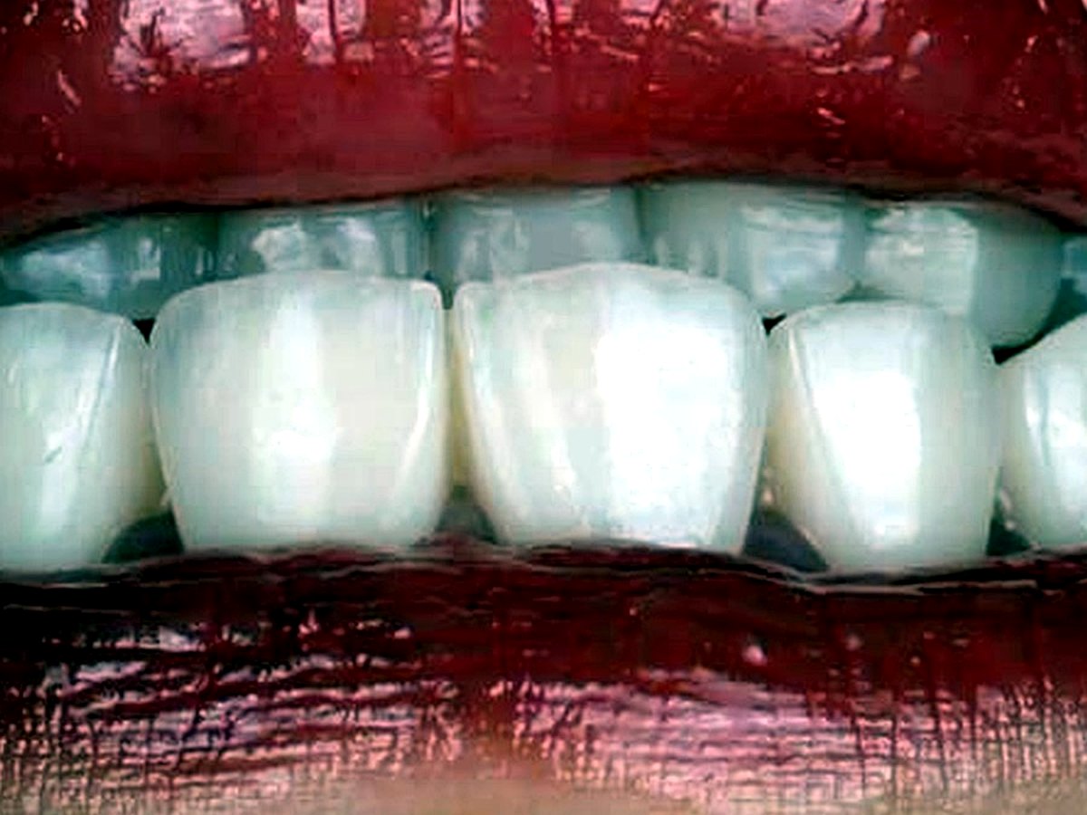 Après facettes dentaires E-max à Tanger : sourire harmonieux et naturel — Dr El Mestari
