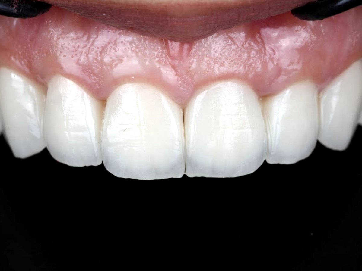 Après implantologie à Tanger : dent remplacée par implant et couronne céramique — Dr El Mestari