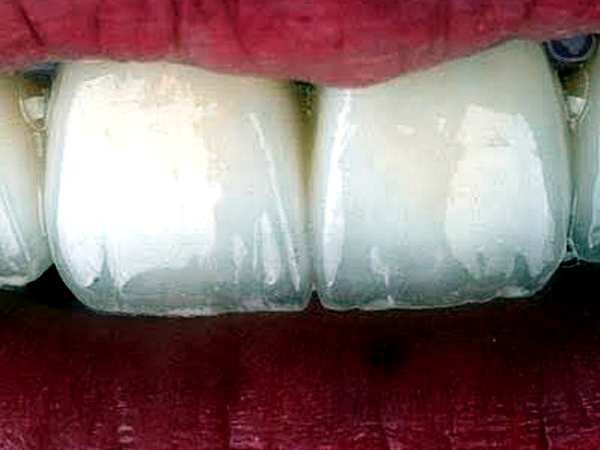 Après lip filler à l'acide hyaluronique à Tanger : lèvres harmonieuses et naturelles — Studio Smile