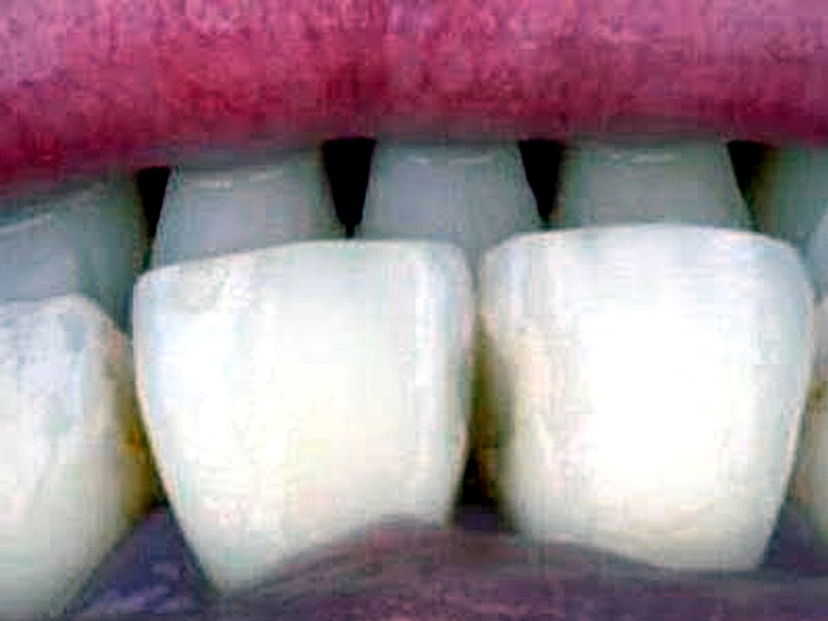Avant lip filler à Tanger : lèvres fines