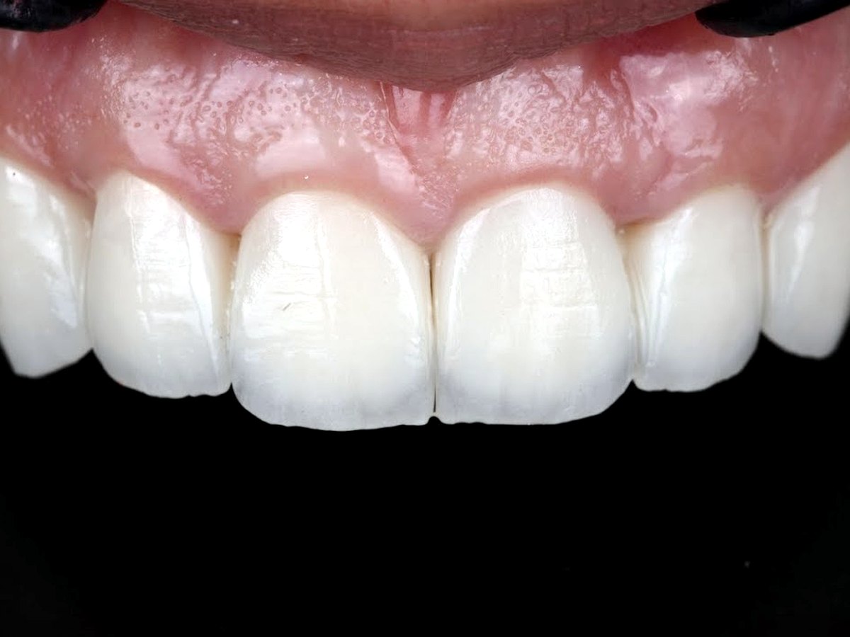 Après traitement par aligneurs invisibles à Tanger : dents alignées — Studio Smile