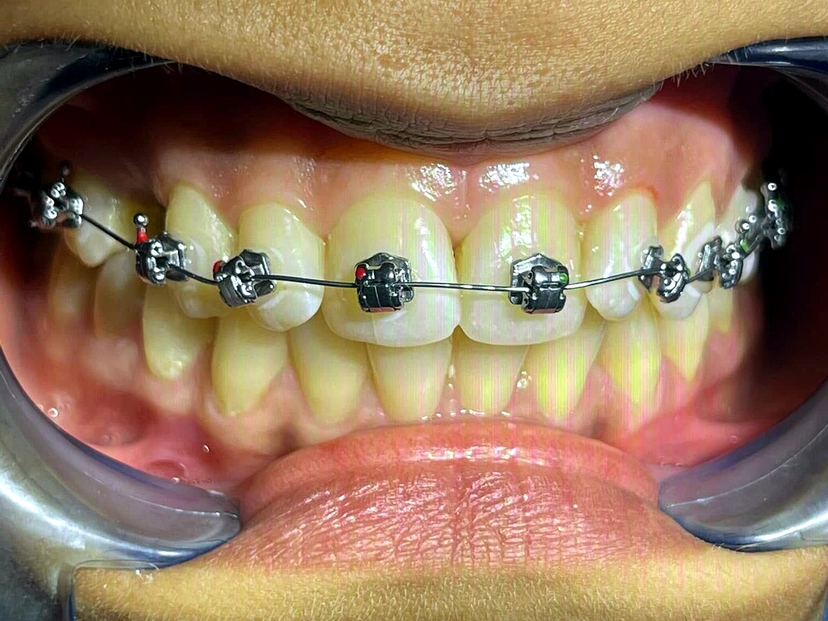 Avant orthodontie à Tanger : dents chevauchées