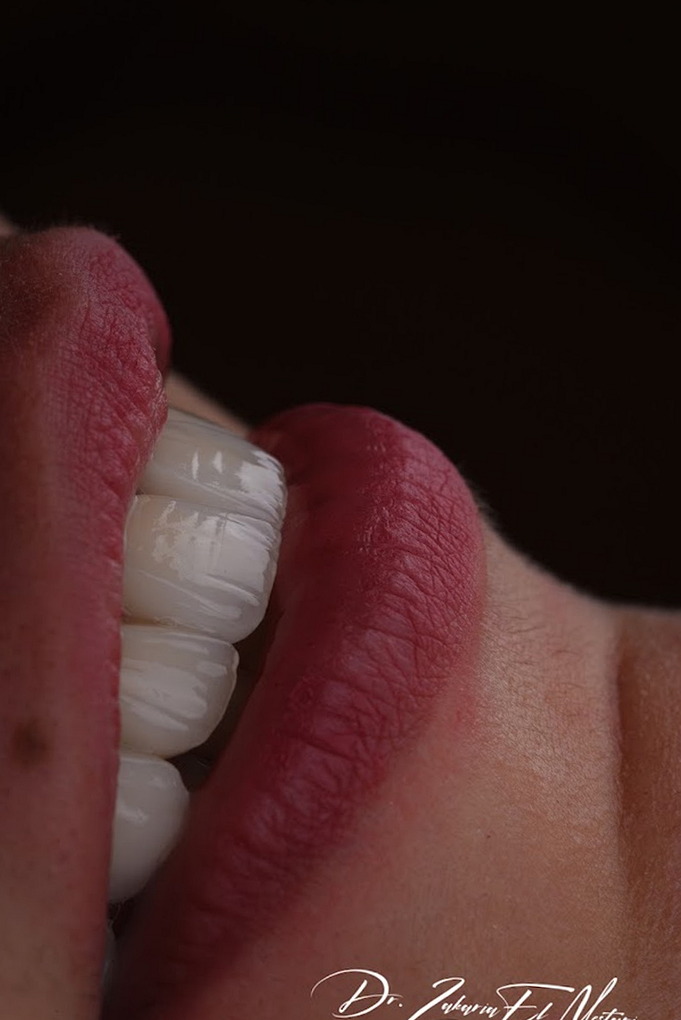 Sourire aux facettes E-max réalisé par le Dr Zakaria El Mestari, dentiste à Tanger