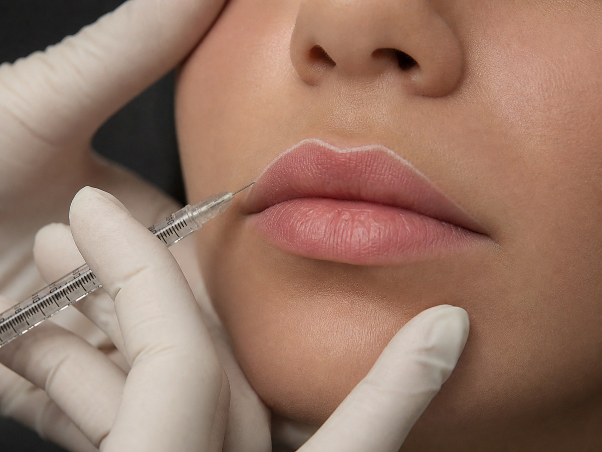 Illustration réaliste d'une consultation lip filler naturelle à l'acide hyaluronique à Tanger